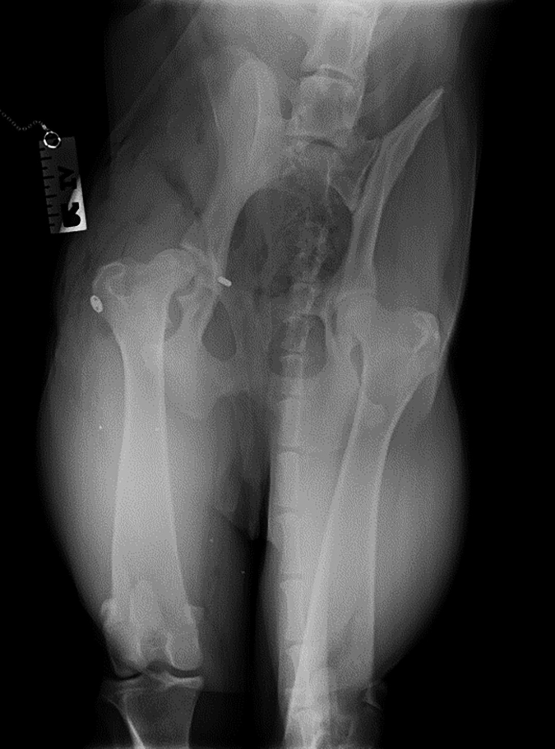 Figure 3 Post-operative radiograph; hip toggle-pin on right side