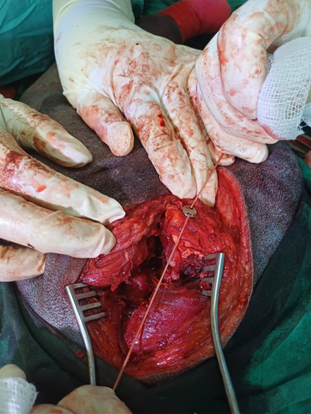 Figure 6 Securing the button by pulling suture and making knot thereby reducing the luxation