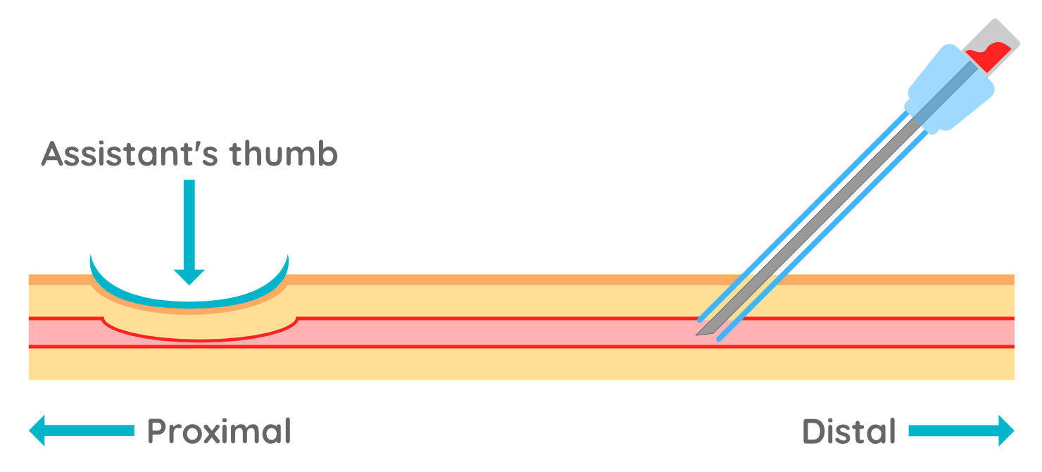 Intravenous catheter placement // WVS Academy