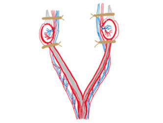 Ovariohysterectomy versus Ovariectomy - which technique should I use?